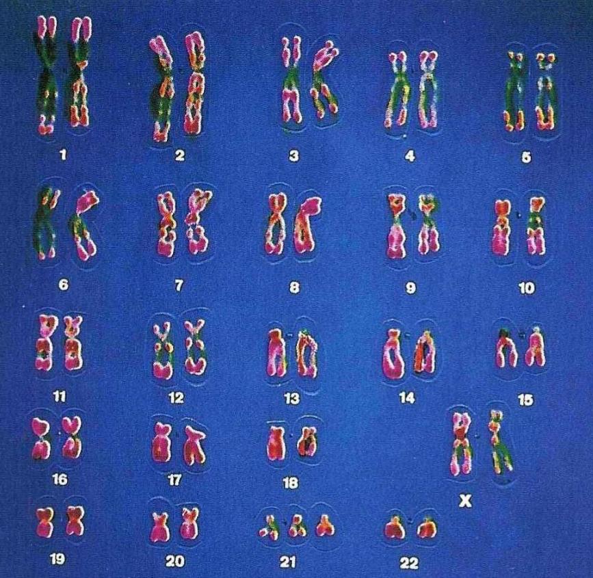 caryotype trisomie21